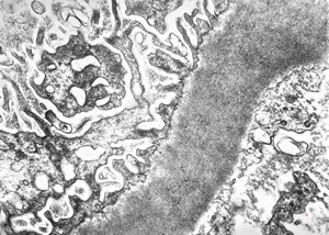 M,22y. | type II membranoproliferative glomerulonephritis M,22y. | type II membranoproliferative glomerulonephritis